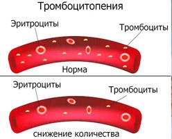 Как проявляется тромбоцитопения