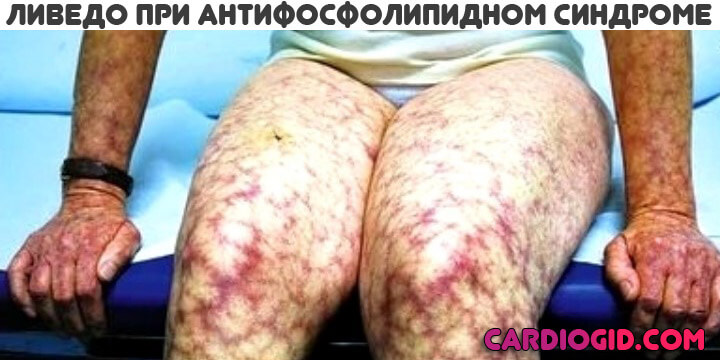 ливедо