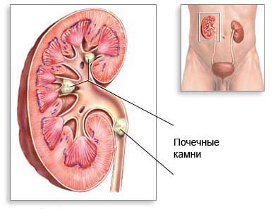Локализация камней в почке