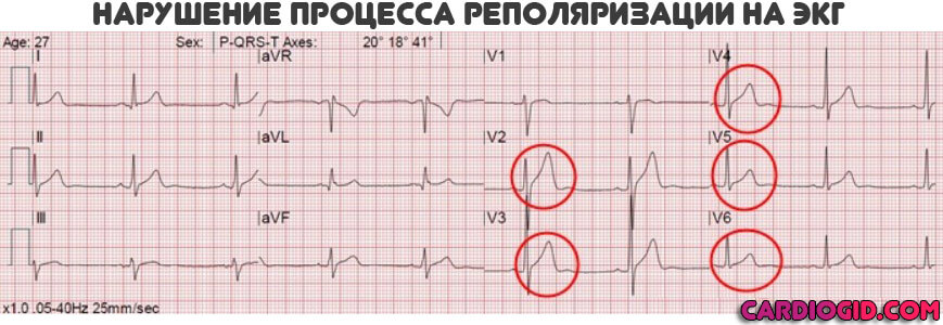 нарушение-реполяризации-на-экг