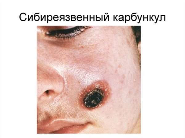 Код мкб 10 фурункул