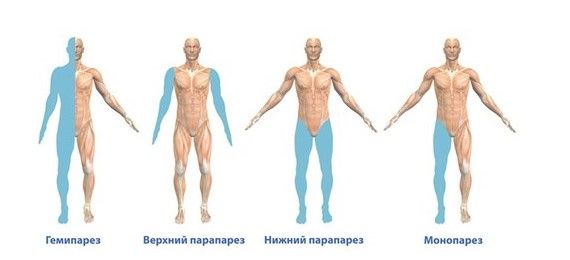 Виды парезов 