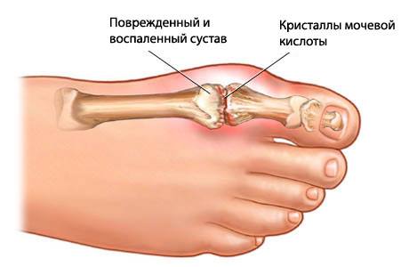 Характерное поражение I плюсневого сустава при подагре