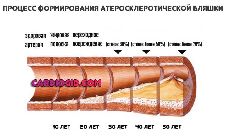 процесс формирования атеросклеротической бляшки