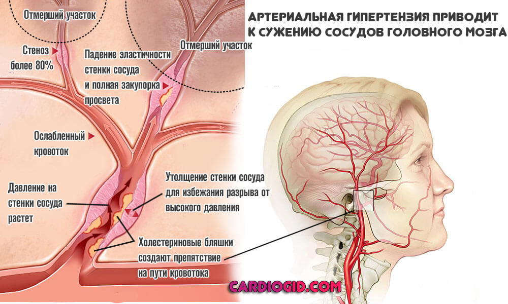 Дисциркуляторная энцефалопатия (ДЭП) 2 степени: что это такое, симптомы, лечение и прогноз жизни
