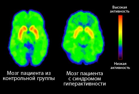 СДВГ у взрослых