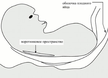 Комбинированный скрининг на синдром Дауна