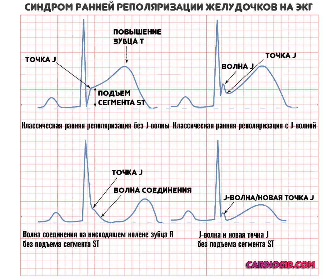 синдром-ранней-реполяризации-на-экг