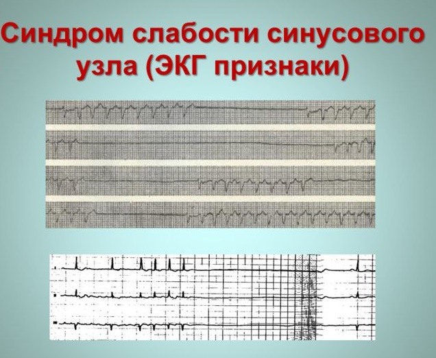 Синдром слабости синусового узла (ЭКГ)