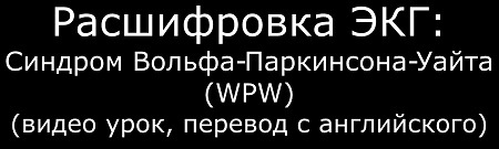 Видео ЭКГ при синдроме WPW (Вольфа-Паркинсона-Уайта)