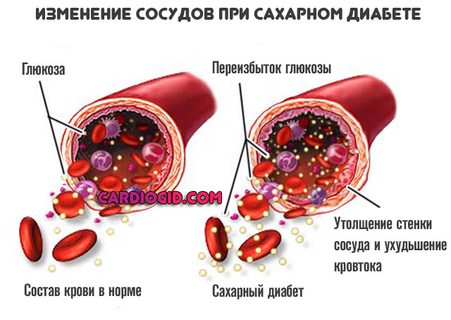 сосуды-при-диабете