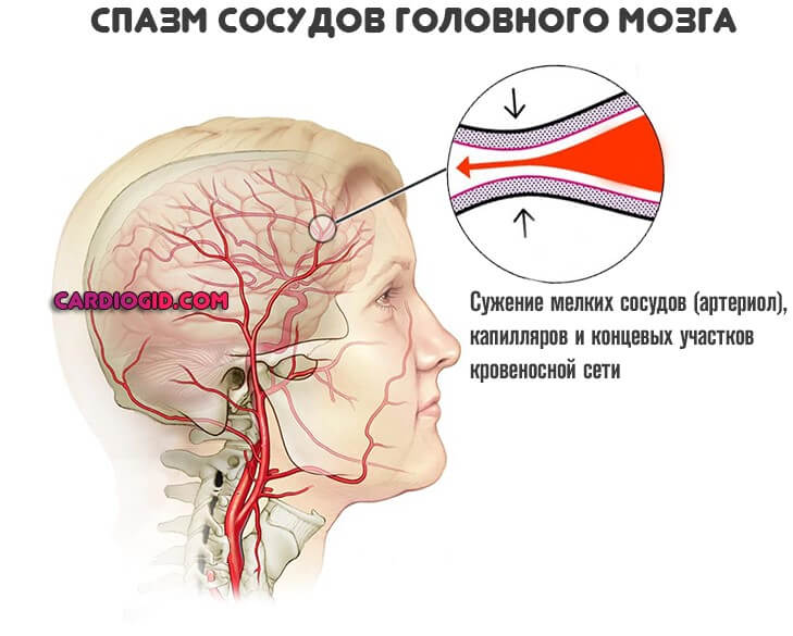 спазм сосудов головного мозга