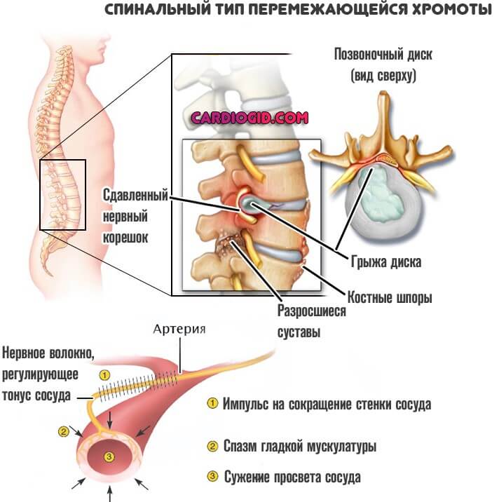 спинальная перемежающаяся хромота