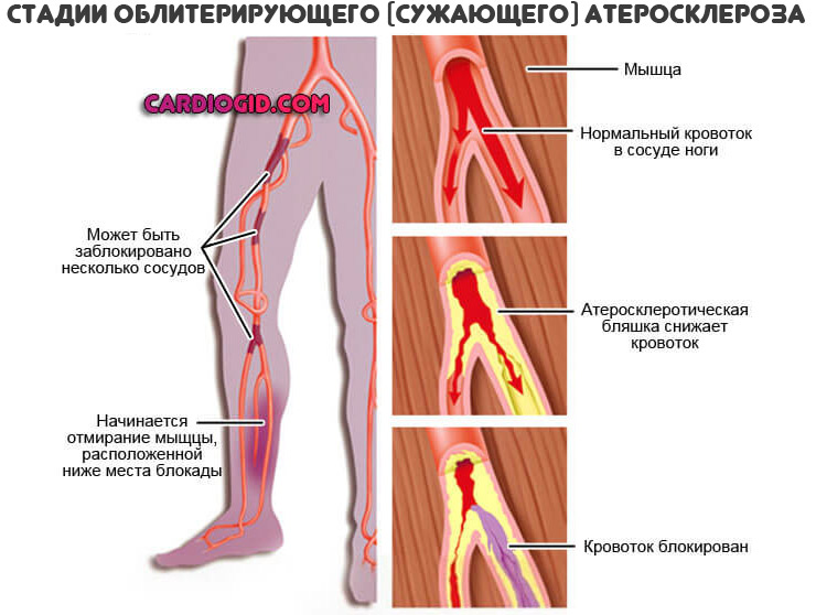 стадии-облитерирующего-атеросклероза