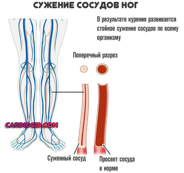 сужение-сосудов-ног
