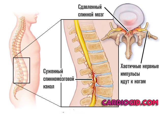 сужение-спинномозгового-канала