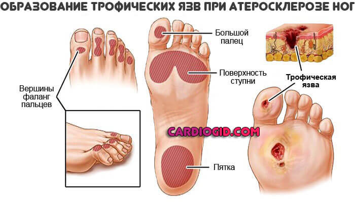 трофические-язвы