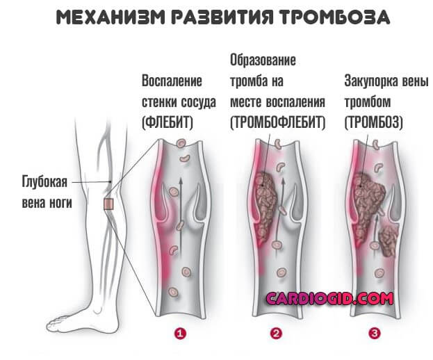 тромбоз