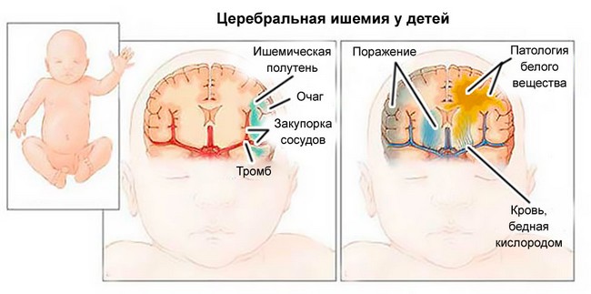 Церебральная ишемия у детей