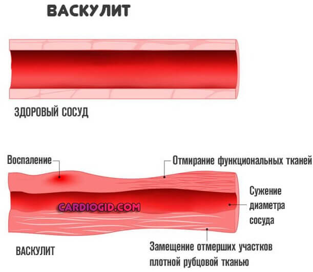 васкулит