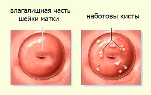 множественные кисты