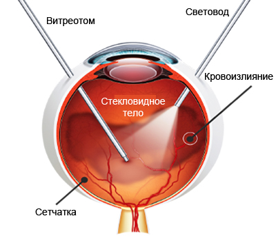vitrektomiya-gemoftalma
