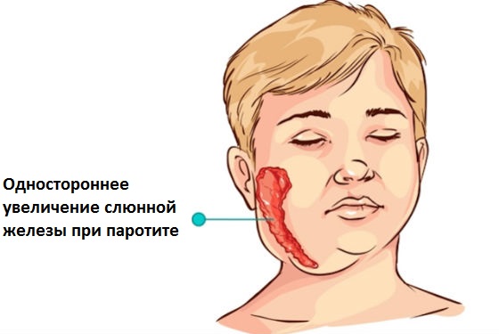 воспаление околоушной слюнной железы изнутри