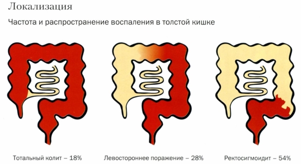 Варианты локализации воспалительного процесса при хроническом колите.