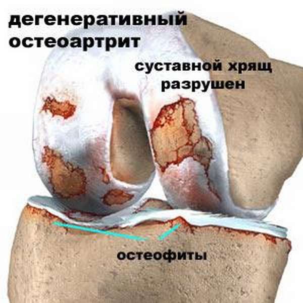 Лечение болевого синдрома при гонартрозе