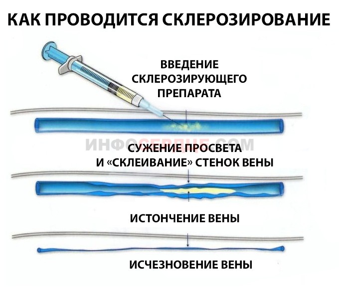 Склерозирование