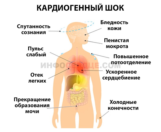 кардиогенный шок