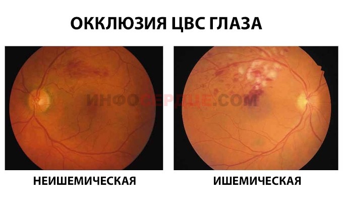 Виды окклюзии