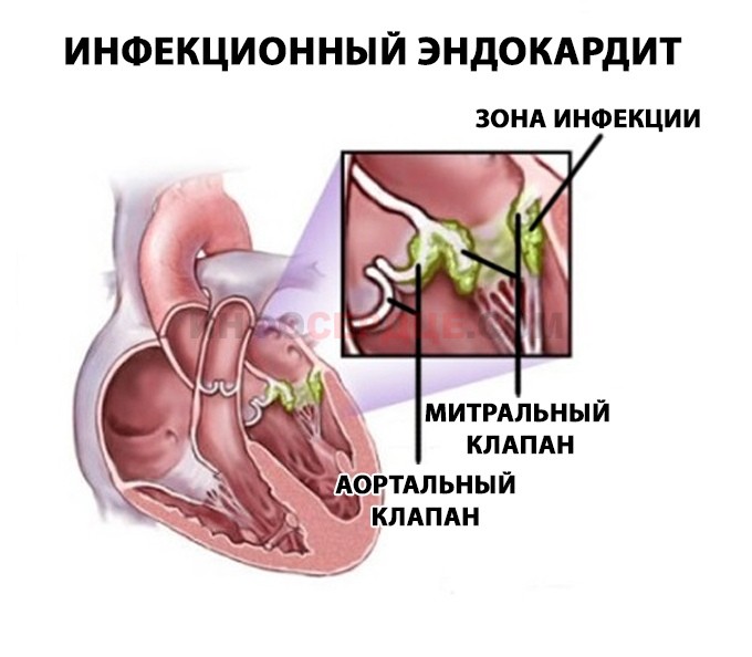 Инфекционный эндокардит