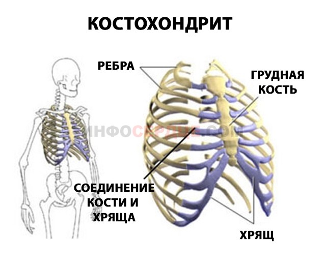 Кострохондрит