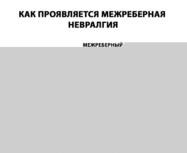 Межреберная невралгия