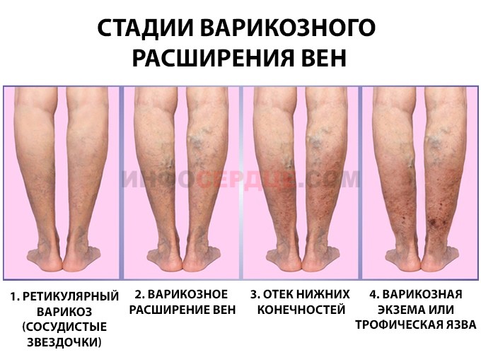 Стадии развития варикоза