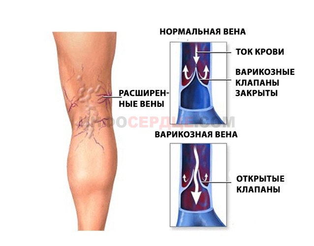 Венозные клапаны