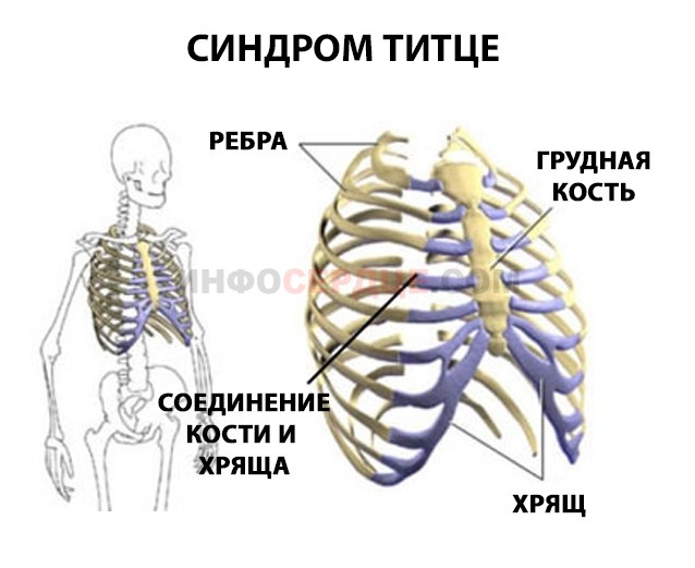 Синдром Титце