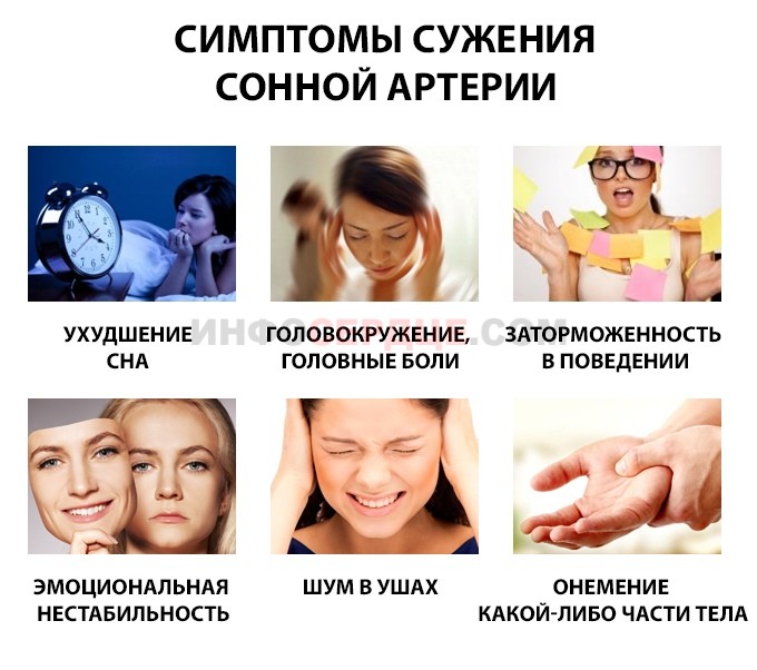 Симптомы стеноза