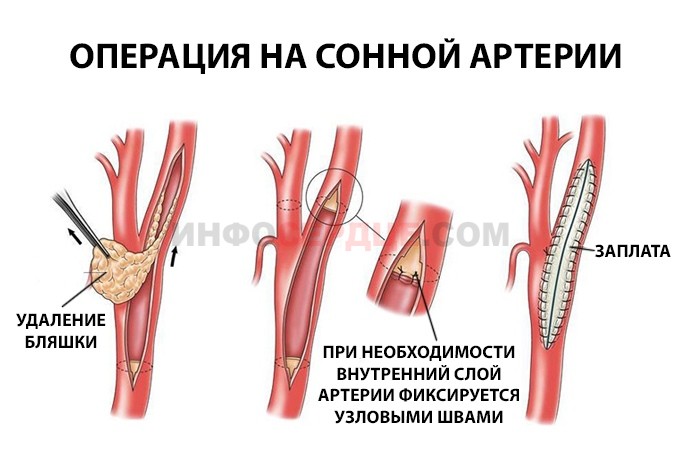 Процесс проведения операции по устранению стеноза