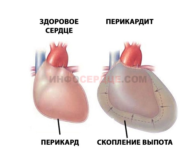 Перикардит