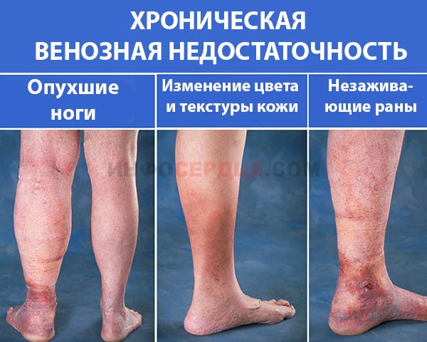 Фото хронической венозной недостаточности ног