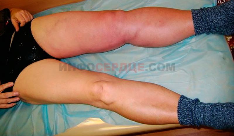 пациент с илеофеморальным тромбозом