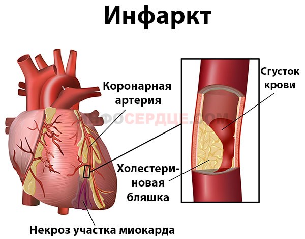 Что происходит во время инфаркта?