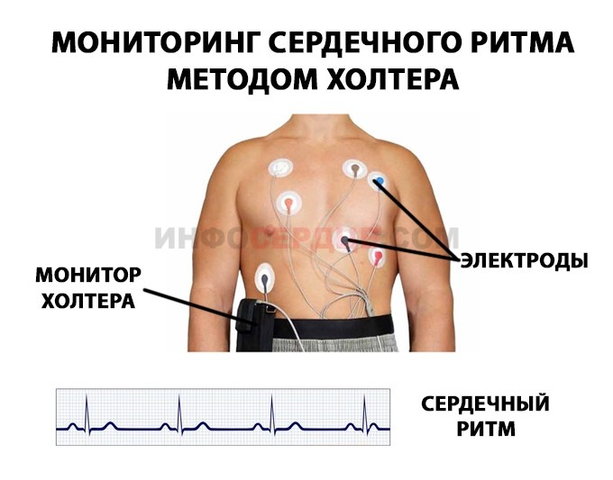 Холтеровское мониторирование