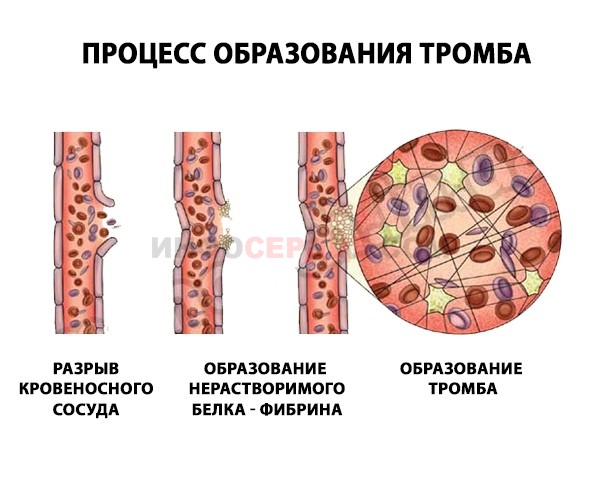 Процесс образования тромбов