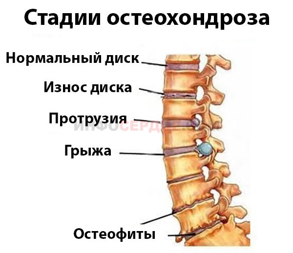 Стадии остеохондроза