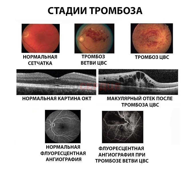 Стадии развития тромбоза