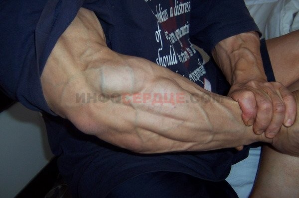 Выступающие вены у юодибилдеров