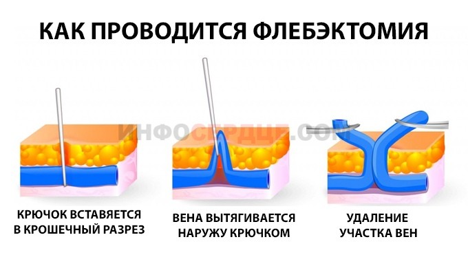 Флебэктомия